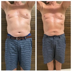 body contouring Boca Raton