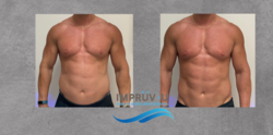 body contouring Cryoslimming in Boca Raton