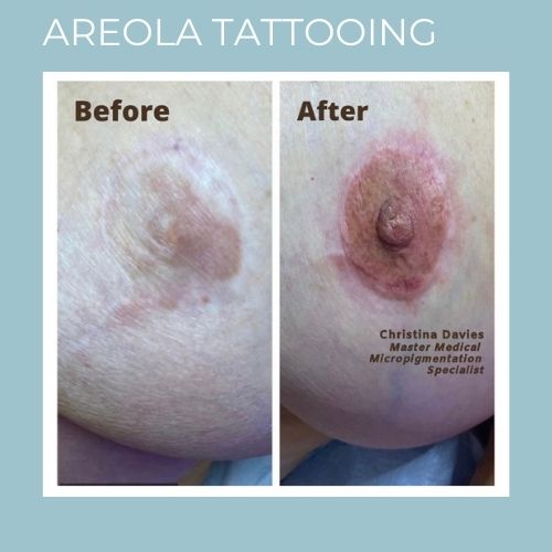 Areola Tattooing
