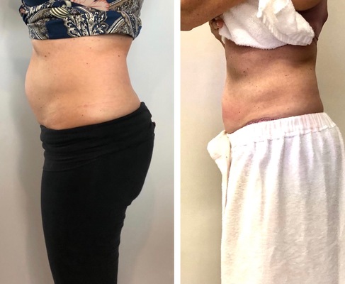 body contouring with Cryoslimming