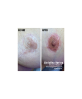 Areola and Nipple Tattooing for Breast Cancer Survivors